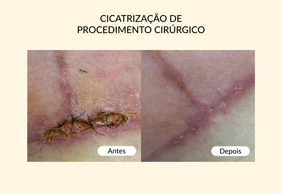 Cicatrização de Procedimento Cirúrgico1.1
