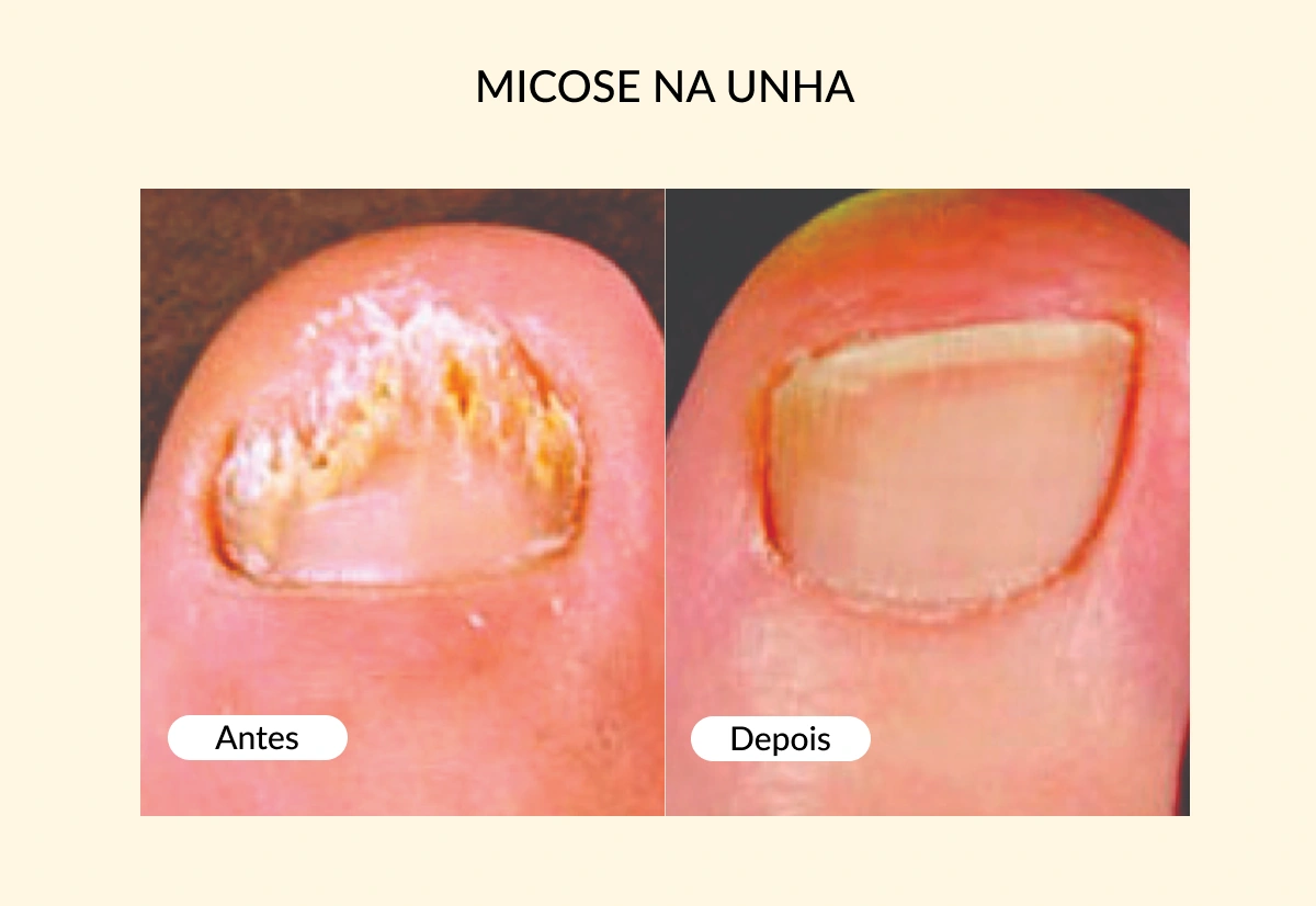 MICOSE NA UNHA