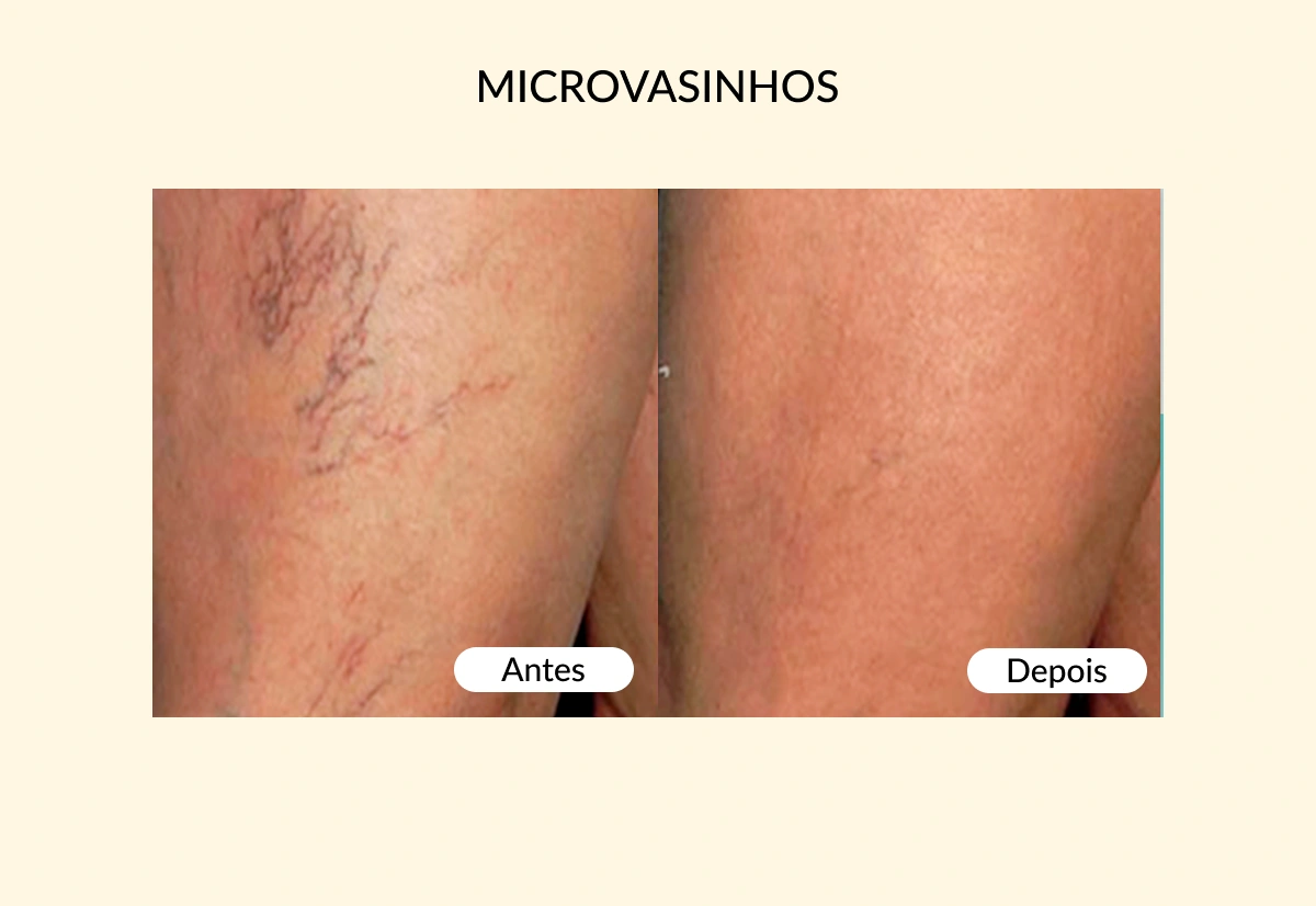 MICROVASINHOS