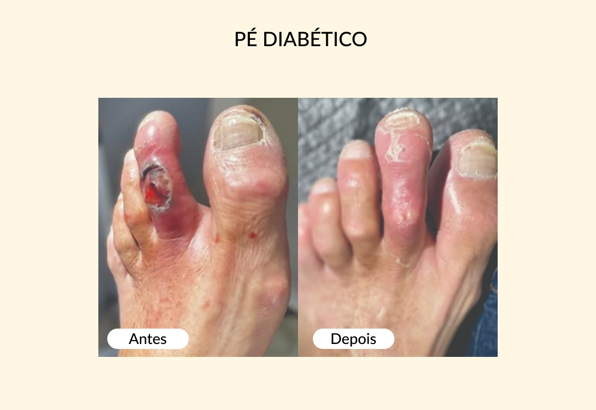 PÉ DIABÉTICO
