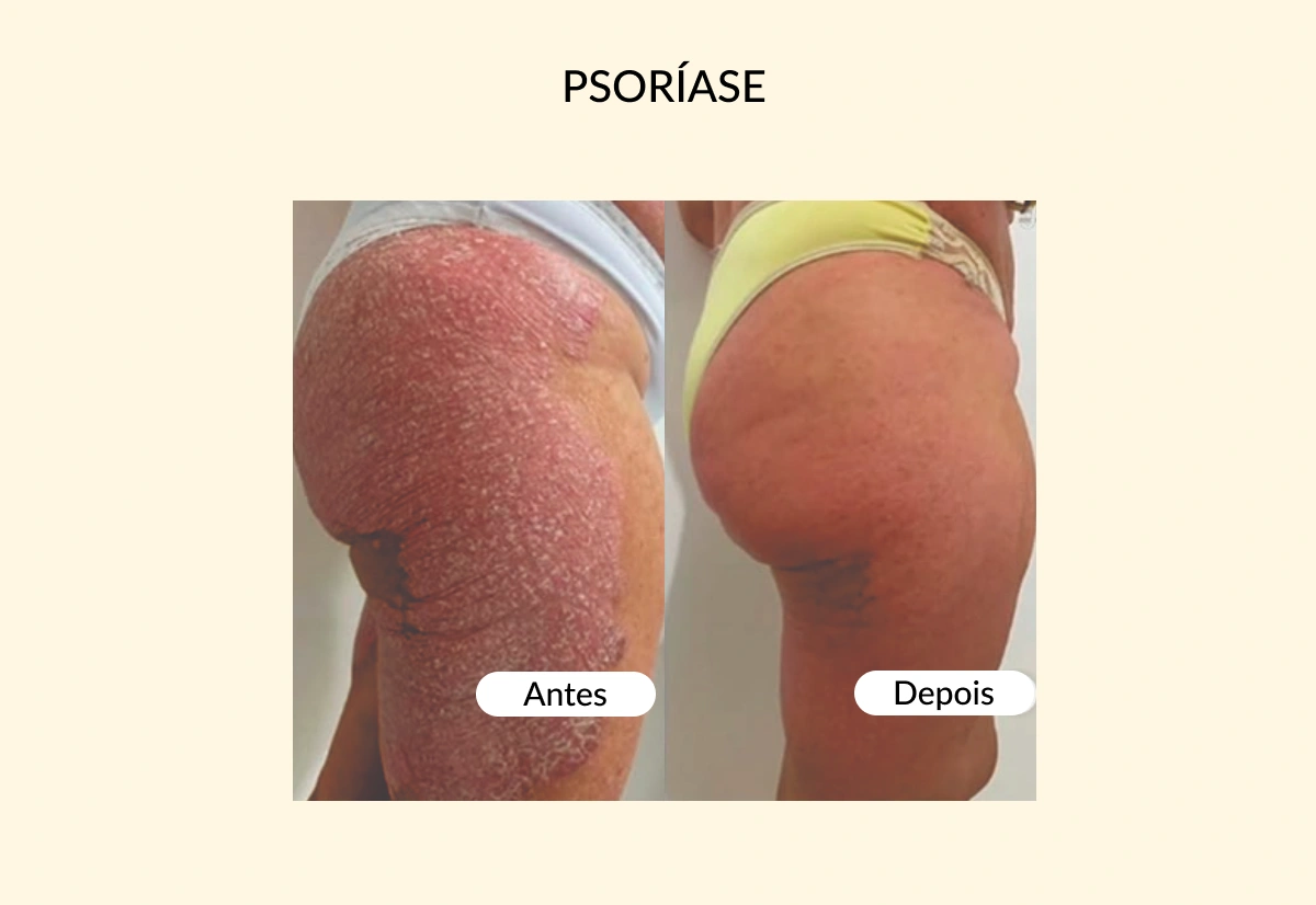 PSORÍASE