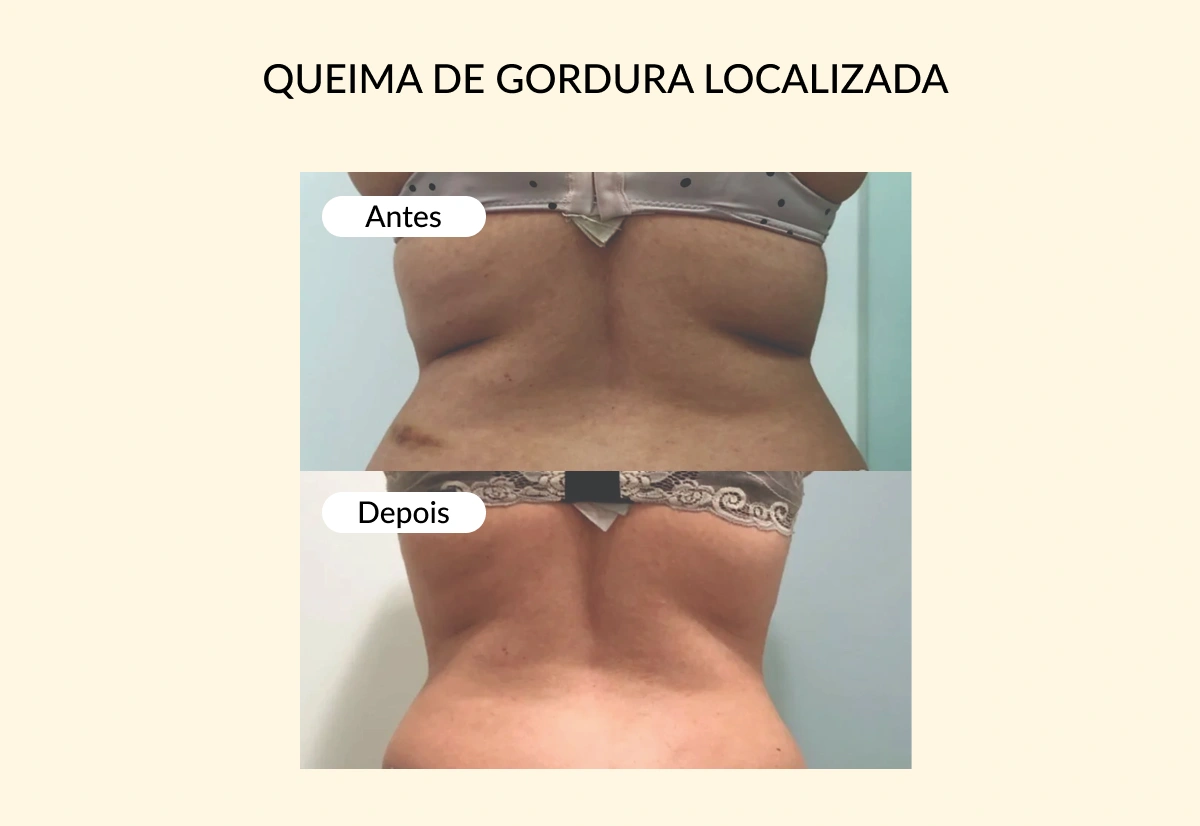 QUEIMA DE GORDURA LOCALIZADA-1