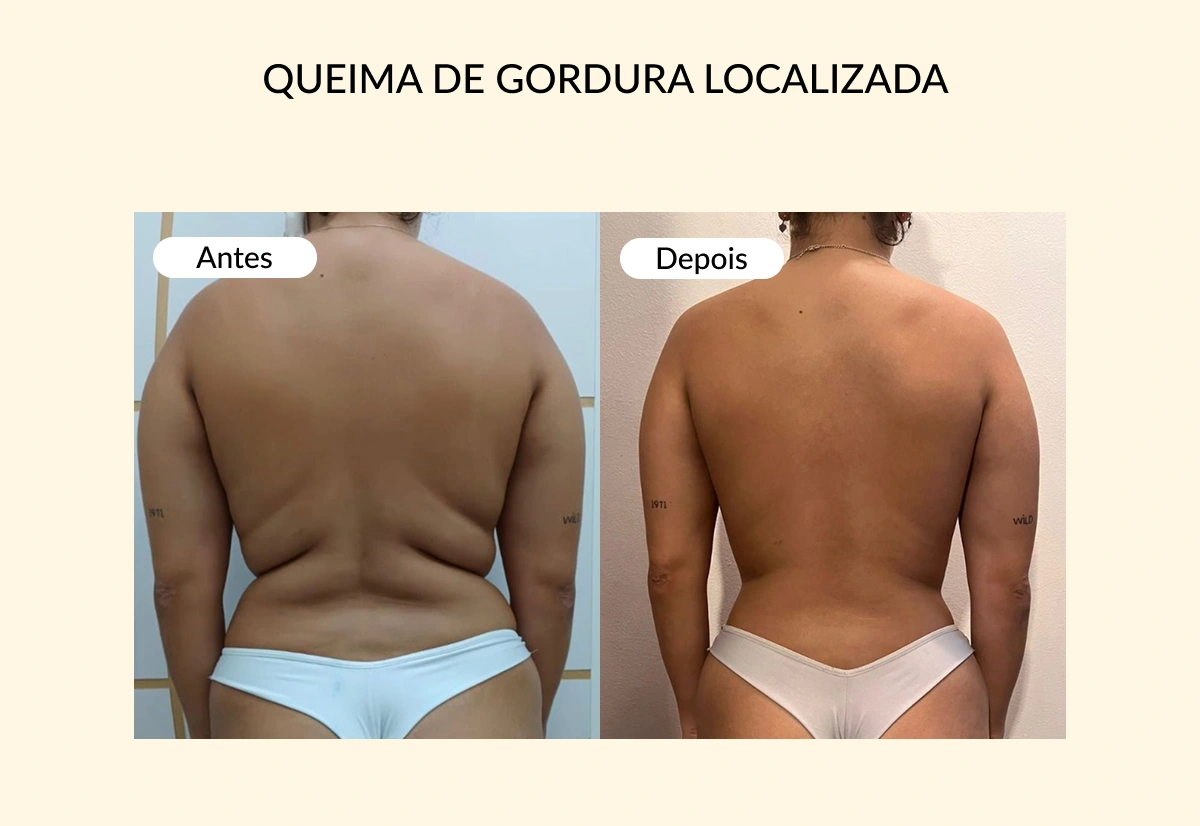 QUEIMA DE GORDURA LOCALIZADA